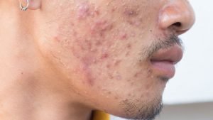 Herpes Zoster dan Jerawat Mirip, Apa Bedanya?