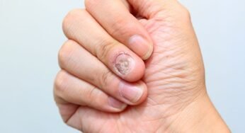 Pengobatan untuk Atasi Masalah Jamur Kuku