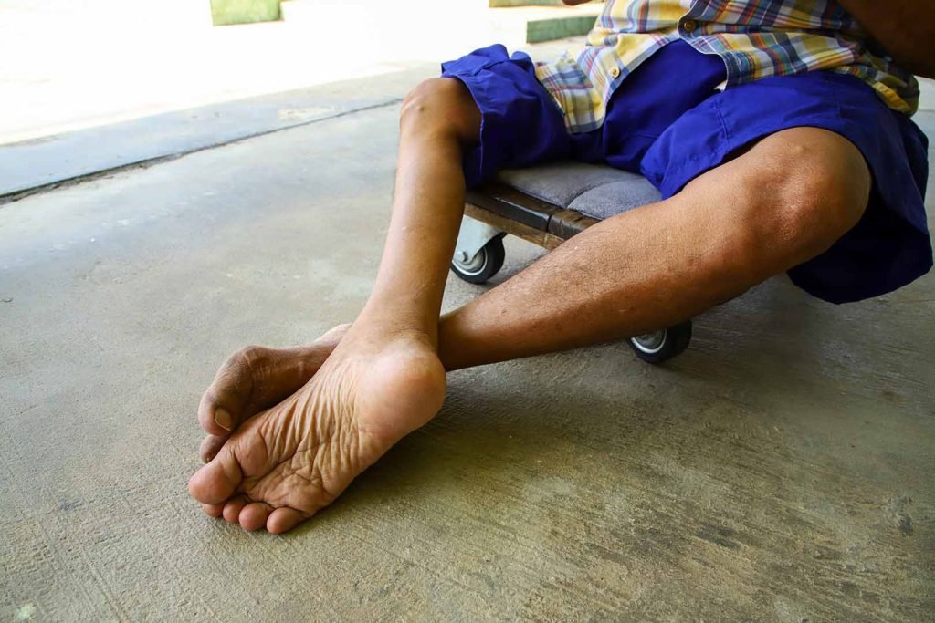 Kasus Polio Kembali Menyerang Indonesia, Kenali Gejalanya