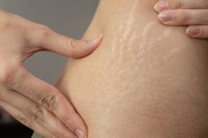 Cara Efektif Menghilangkan Stretch Mark Secara Medis dan Alami