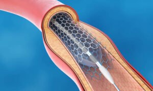 Foto: Ilustrasi ring jantung (Sumber: istock) Foto: Ilustrasi ring jantung (Sumber: istock)