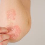 Mengenali Penyakit Psoriasis dan Faktor Penyebabnya