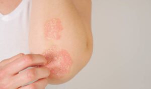 Mengenali Penyakit Psoriasis dan Faktor Penyebabnya