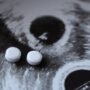 Ilustrasi aborsi/istock